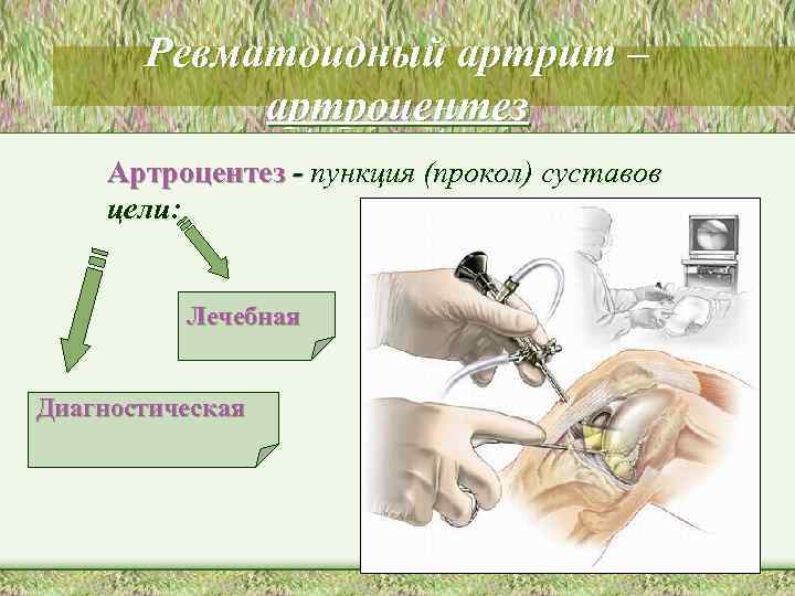 Ревматоидный артрит – артроцентез Артроцентез - пункция (прокол) суставов цели: Лечебная Диагностическая 