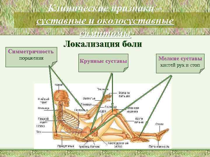 Клинические признаки – суставные и околосуставные симптомы Симметричность поражения Локализация боли Крупные суставы Мелкие