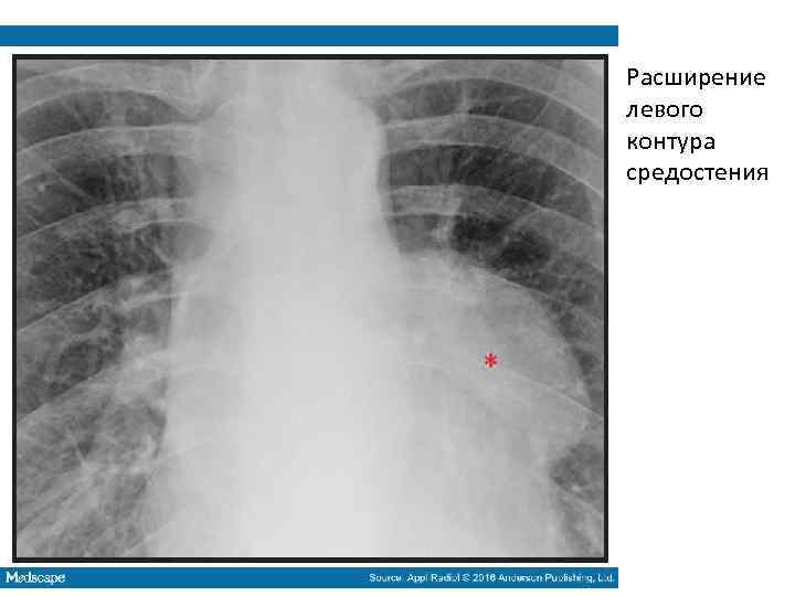 Расширение левого контура средостения 
