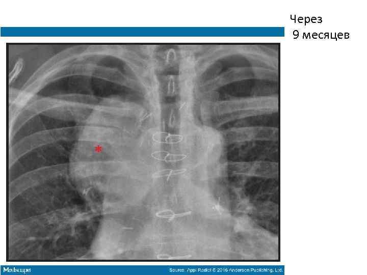 Через 9 месяцев 