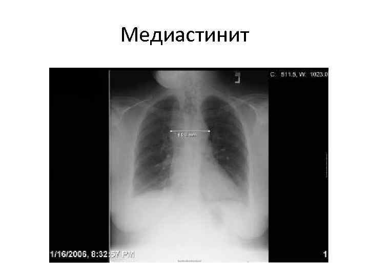 Медиастинит 