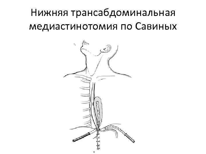 Нижняя трансабдоминальная медиастинотомия по Савиных 
