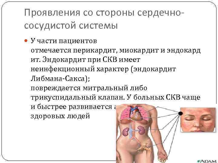 Проявления со стороны сердечнососудистой системы У части пациентов отмечается перикардит, миокардит и эндокард ит.