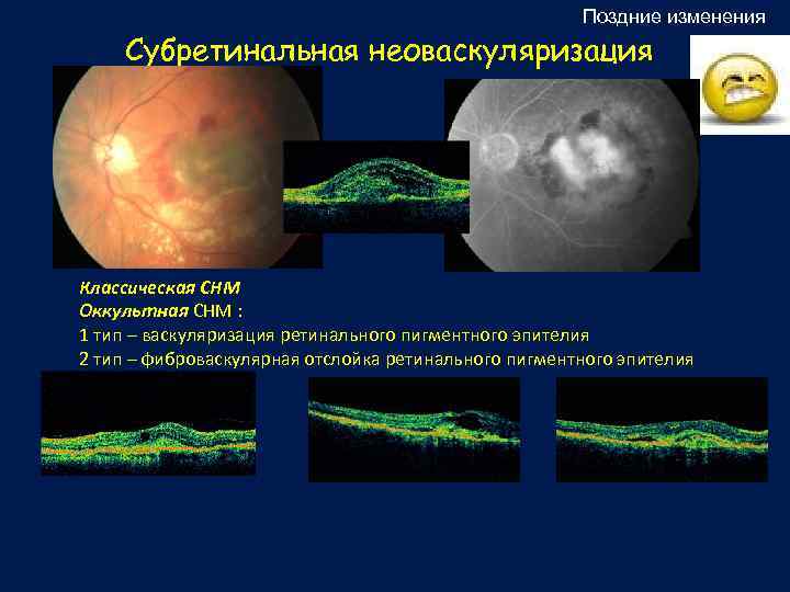 Поздняя смена. Неоваскулярная мембрана на окт. Субретинальная неоваскуляризация. Неоваскулярная отслойка пигментного эпителия. Серозная отслойка пигментного эпителия.