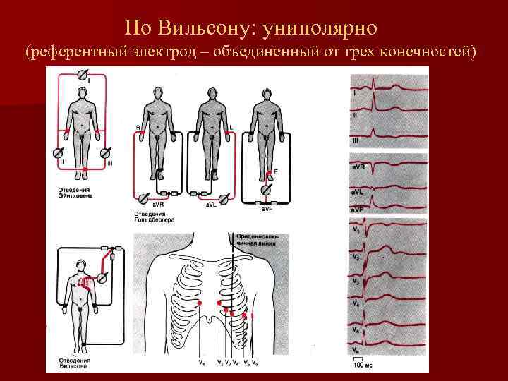 По Вильсону: униполярно (референтный электрод – объединенный от трех конечностей) 