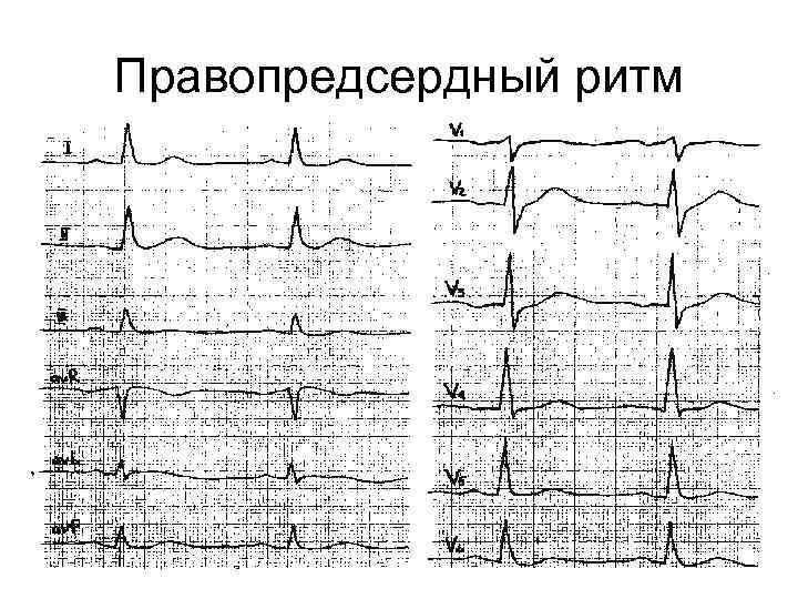 Правопредсердный ритм 