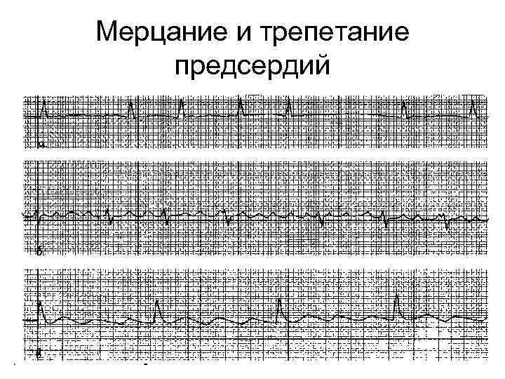 Мерцание и трепетание предсердий 