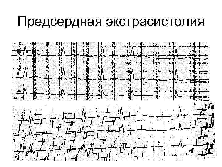 Предсердная экстрасистолия 