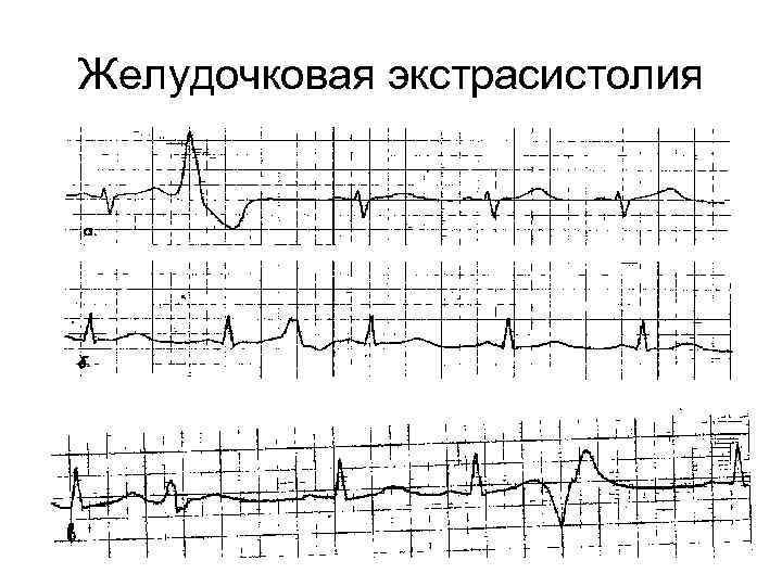 Желудочковая экстрасистолия 
