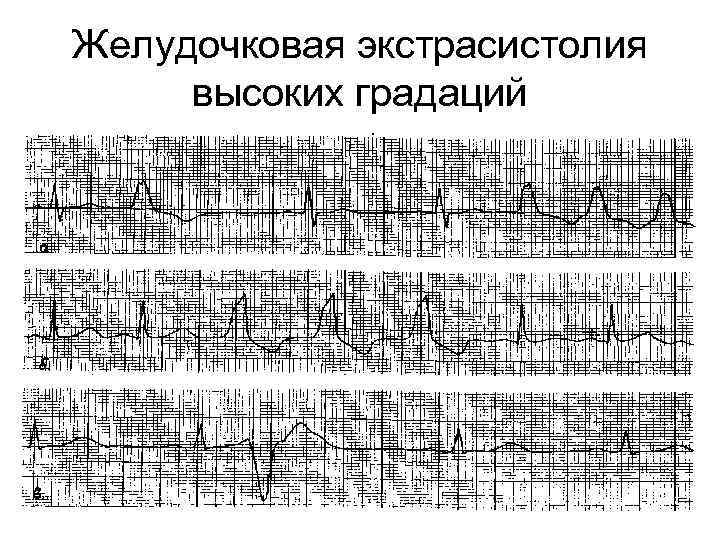 Желудочковая экстрасистолия высоких градаций 