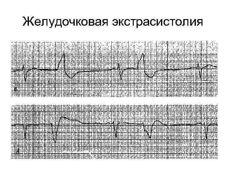 Желудочковая экстрасистолия 
