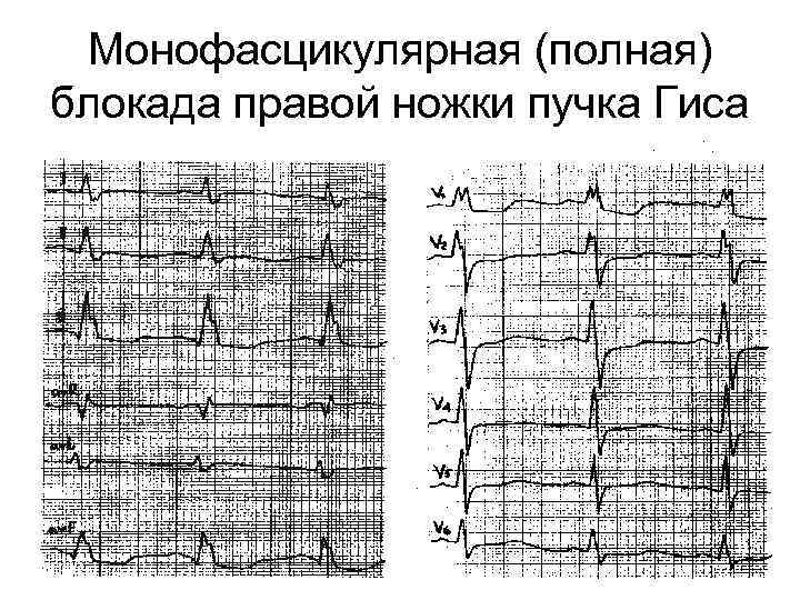 Полная блокада правой ножки гиса. ЭКГ при блокаде правой ножки. ЭКГ при полной блокаде правой ножки п.Гиса. Бифасцикулярная блокада на ЭКГ. Полная блокада правой ножки.