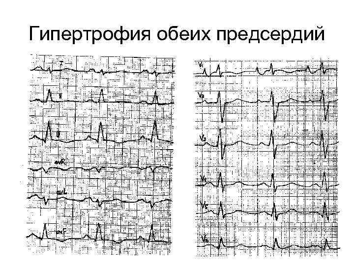 Гипертрофия обеих предсердий 