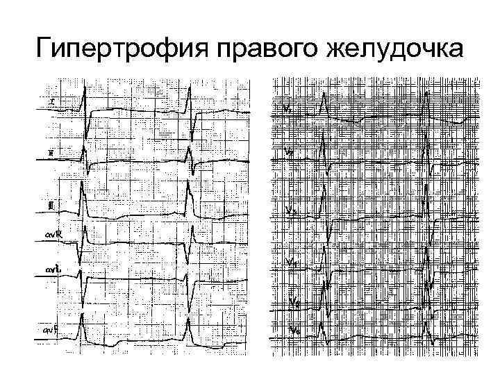 Гипертрофия правого желудочка 
