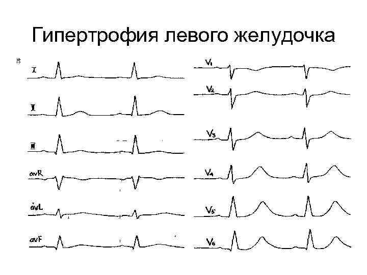 Умеренный ритм миокарда