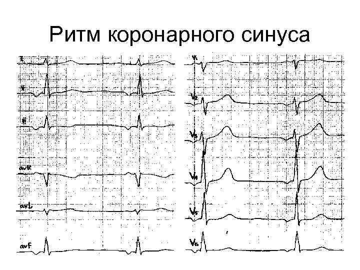 Ибс синусовая брадикардия карта вызова