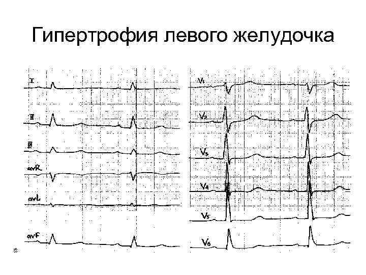 Гипертрофия левого желудочка 