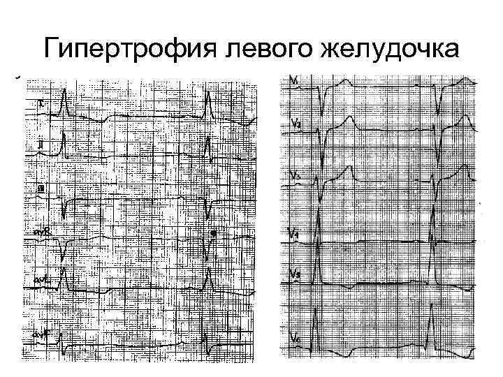 Гипертрофия левого желудочка 
