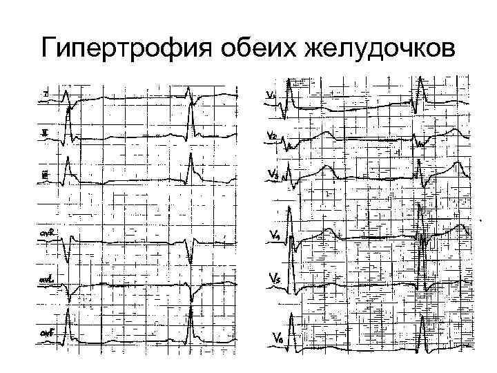 Гипертрофия обеих желудочков 