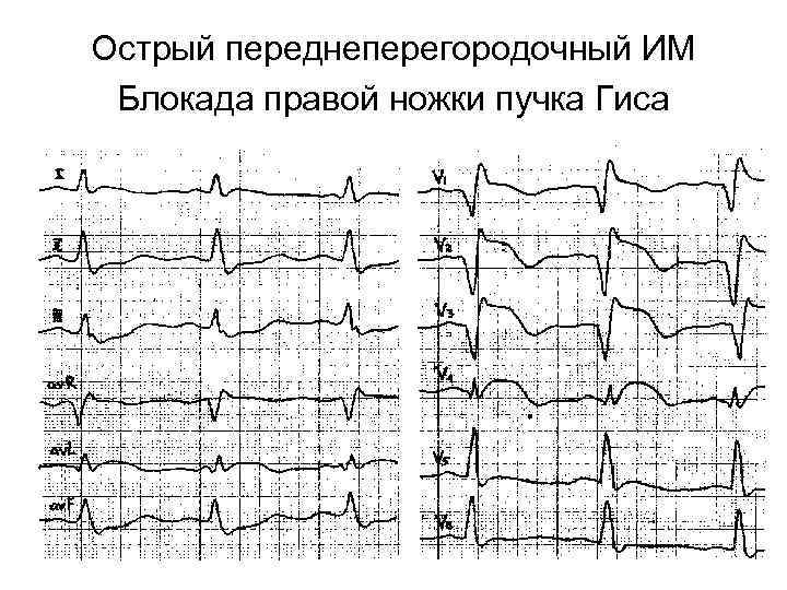 Острый переднеперегородочный ИМ Блокада правой ножки пучка Гиса 