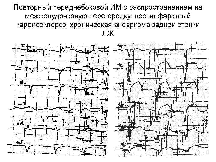 Повторный переднебоковой ИМ с распространением на межжелудочковую перегородку, постинфарктный кардиосклероз, хроническая аневризма задней стенки