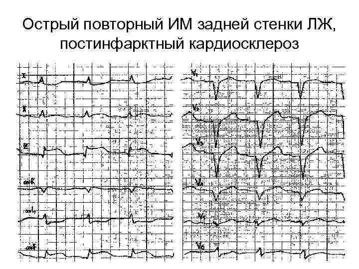 Острый повторный ИМ задней стенки ЛЖ, постинфарктный кардиосклероз 