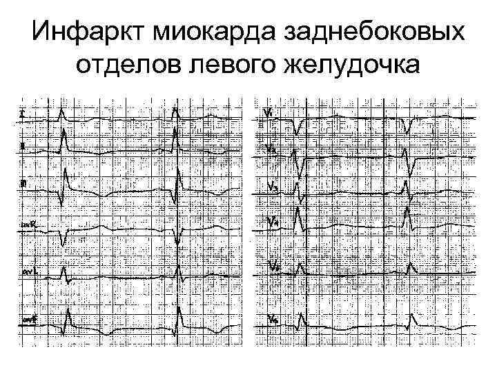 Инфаркт миокарда заднебоковых отделов левого желудочка 