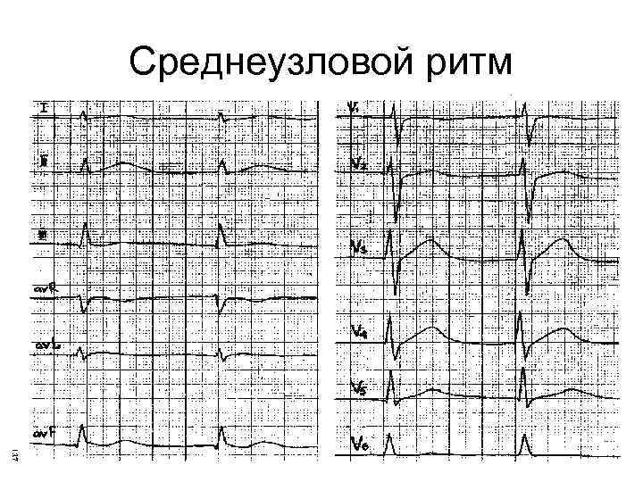 Среднеузловой ритм 