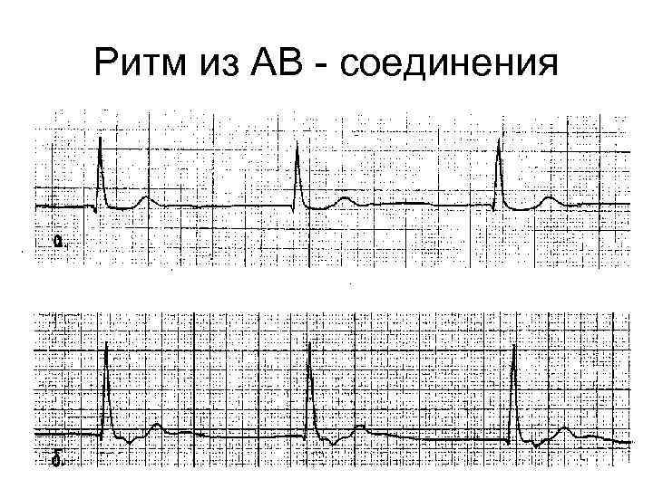 Ритм из ав соединения