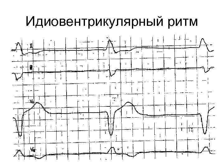 Идиовентрикулярный ритм 