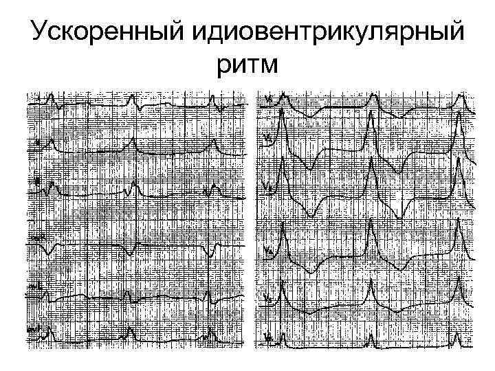 Ускоренный идиовентрикулярный ритм 