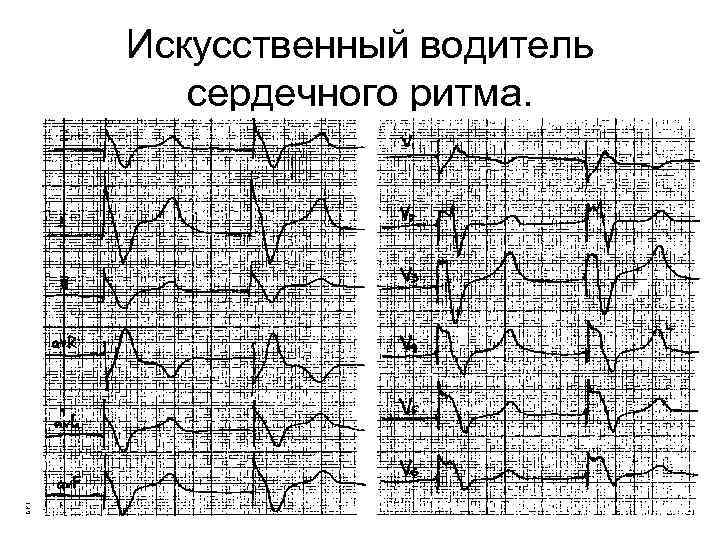 Искусственный водитель сердечного ритма. 