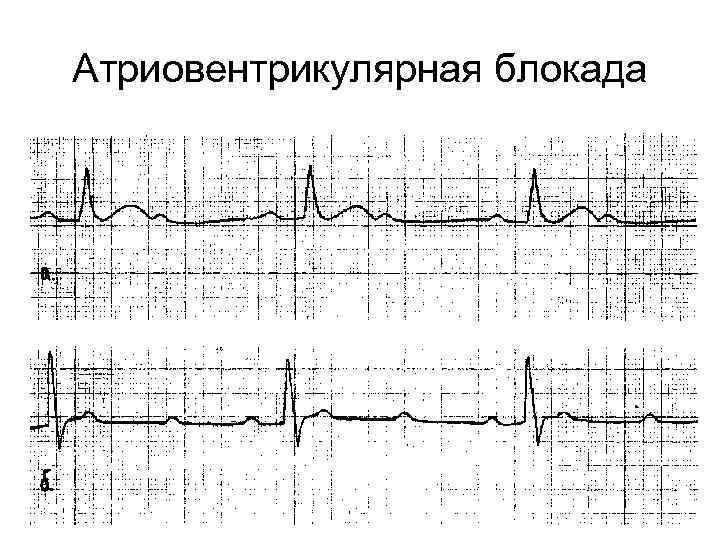 Атриовентрикулярная блокада 