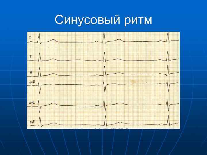 Синусовый ритм 