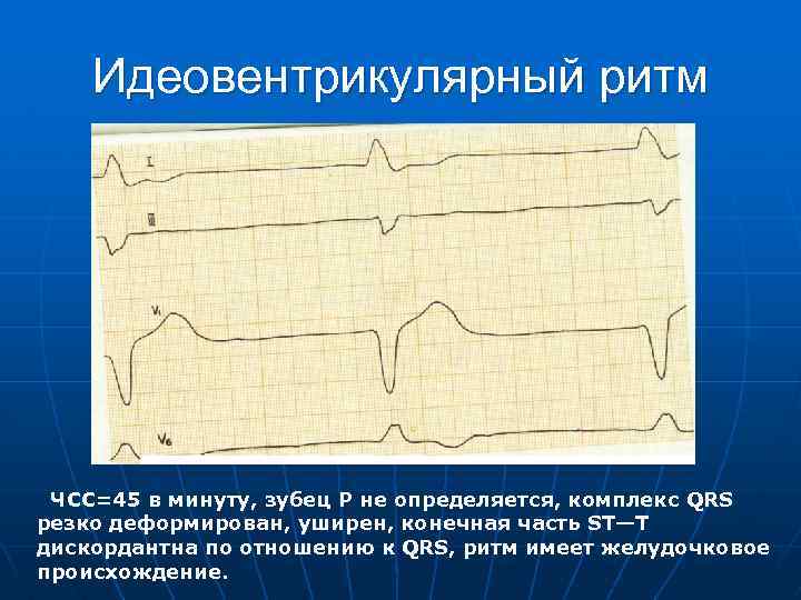 Идеовентрикулярный ритм ЧСС=45 в минуту, зубец Р не определяется, комплекс QRS резко деформирован, уширен,