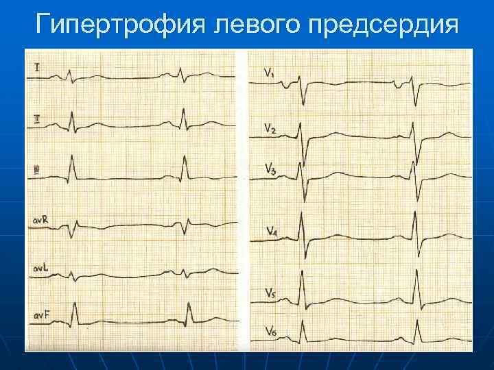 Гипертрофия левого предсердия 