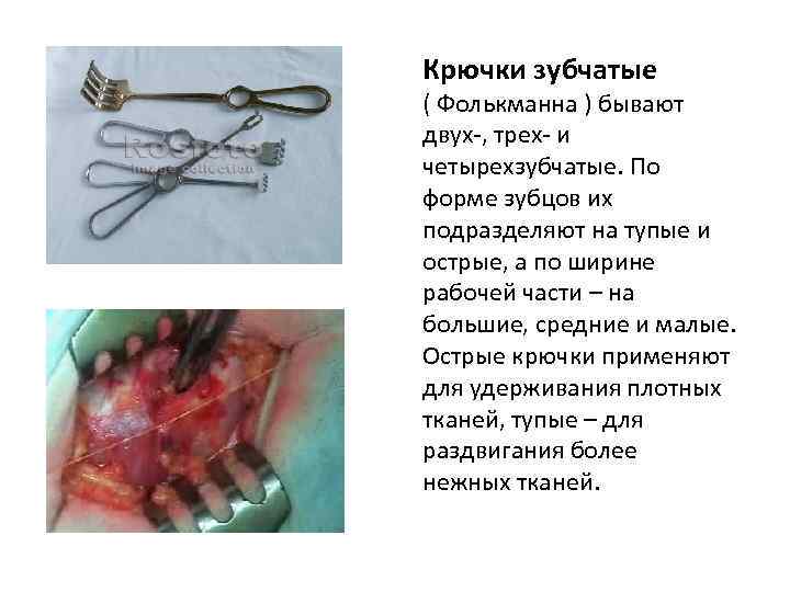 Крючки зубчатые ( Фолькманна ) бывают двух-, трех- и четырехзубчатые. По форме зубцов их