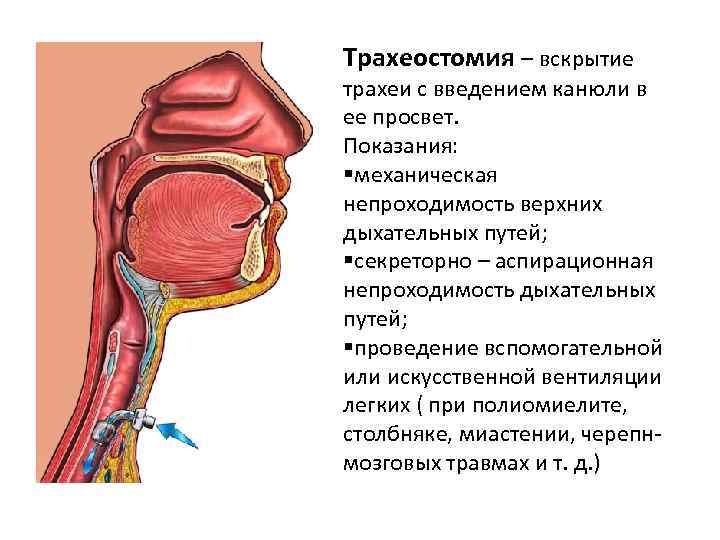 Дыхание через трахеи. Трахеостомия показания.