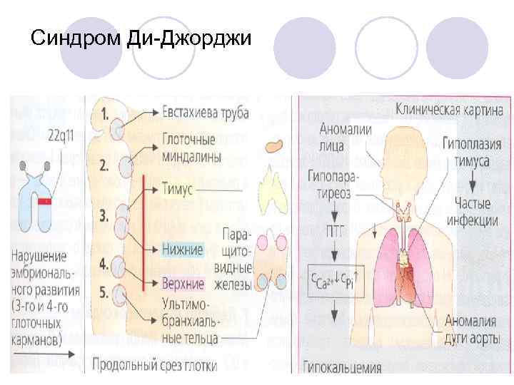 Синдром Ди-Джорджи 