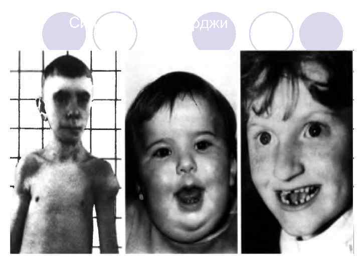  Синдром Ди Джорджи 