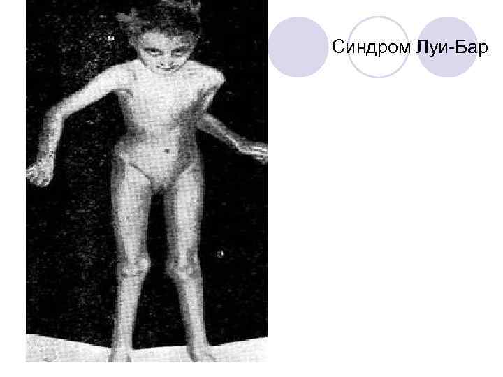 Синдром Луи-Бар 