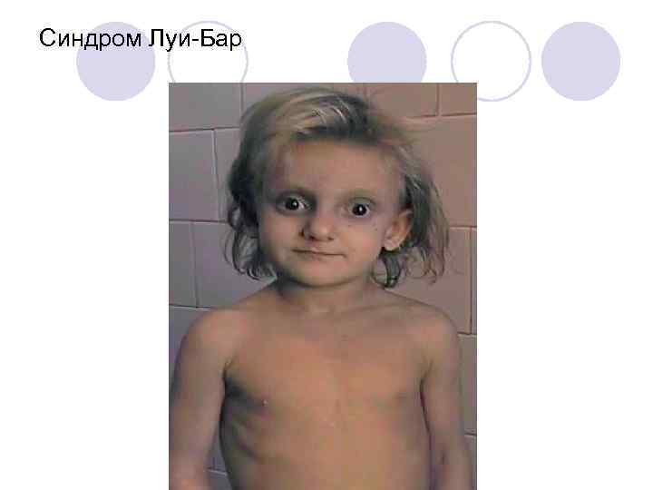 Синдром Луи-Бар 