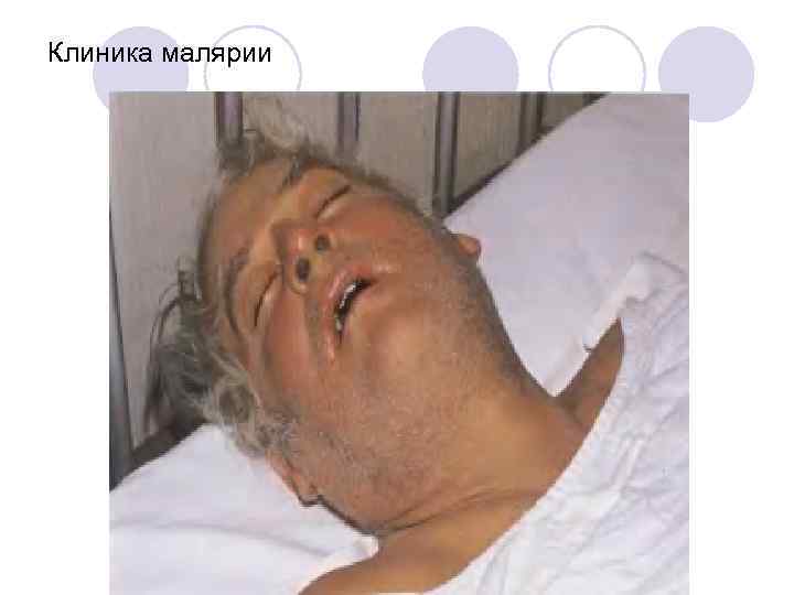 Клиника малярии 