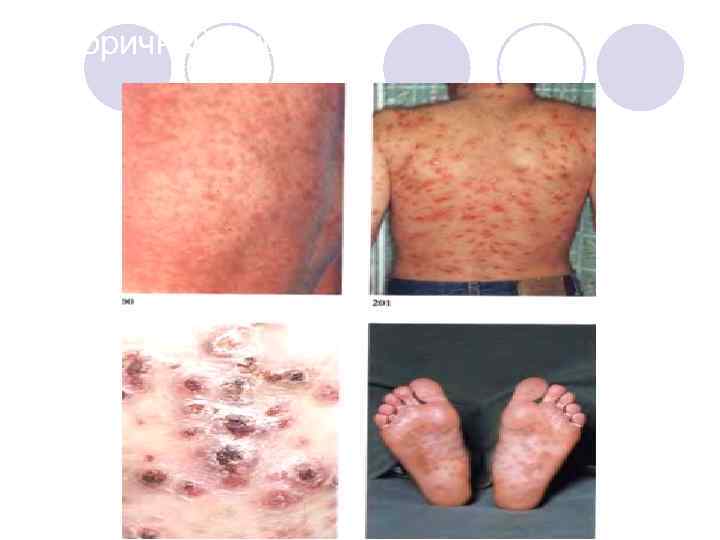 Вторичный сифилис 