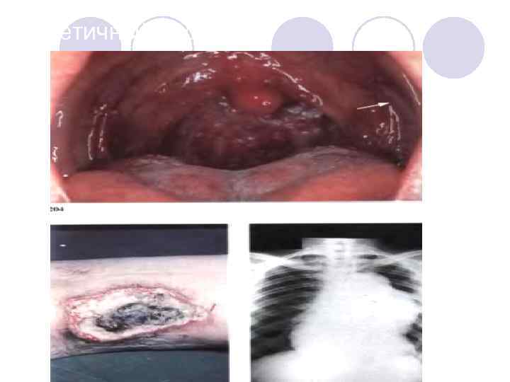 Третичный сифилис 