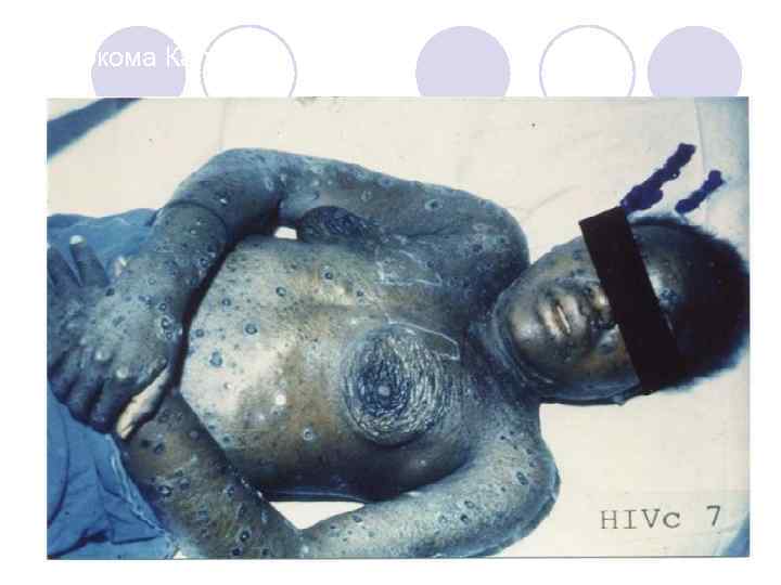 Саркома Капоши 