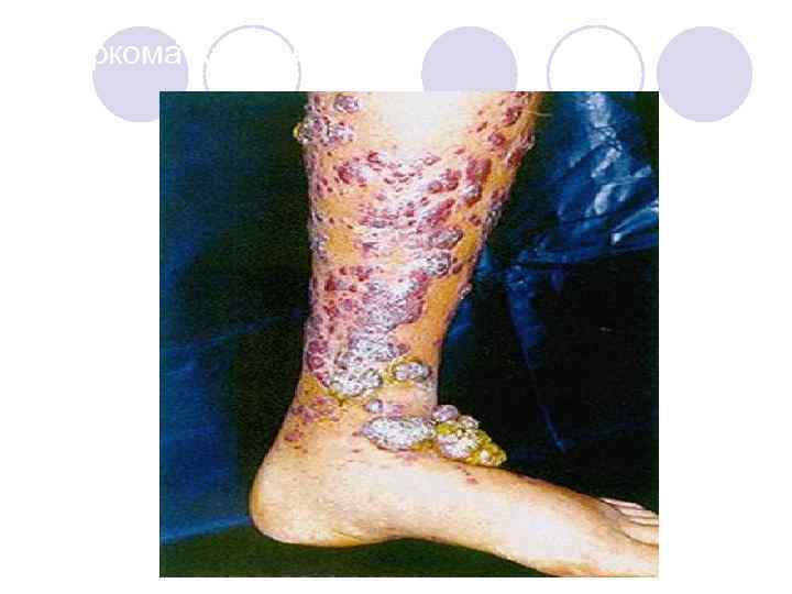 Саркома Капоши 