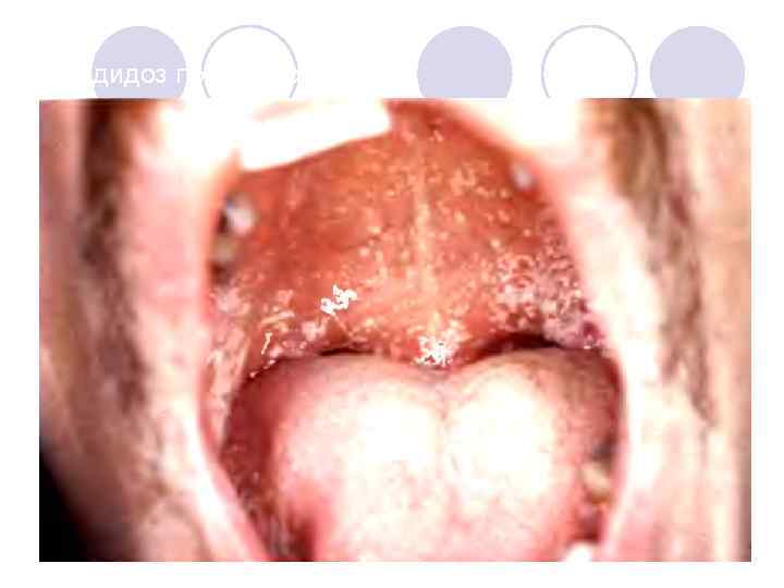Кандидоз полости рта. 