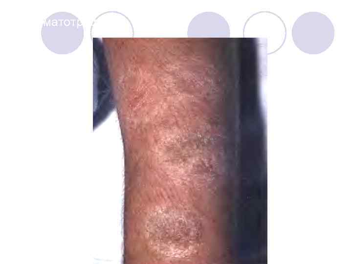 Дерматотрофия. 