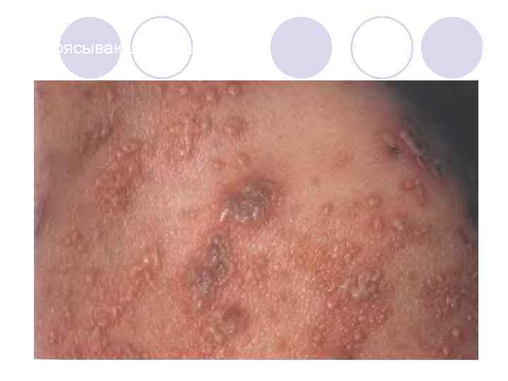 Опоясывающий лишай. 